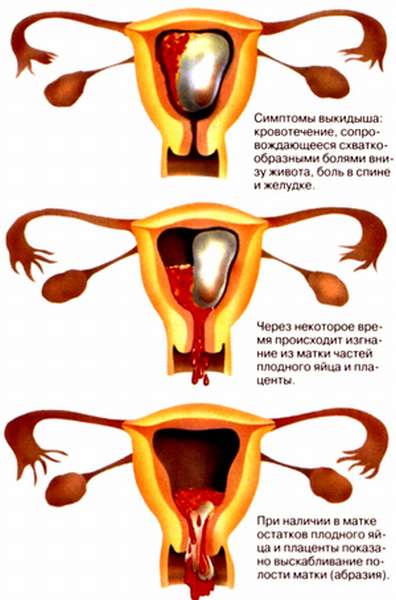 Физиологический аборт