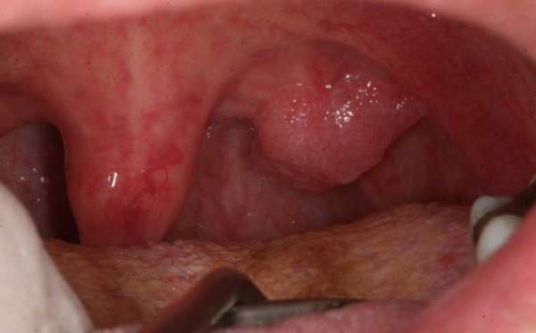 Папиллома на слизистой рта