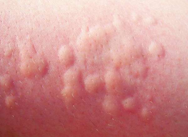 Аллергическая реакция на коже