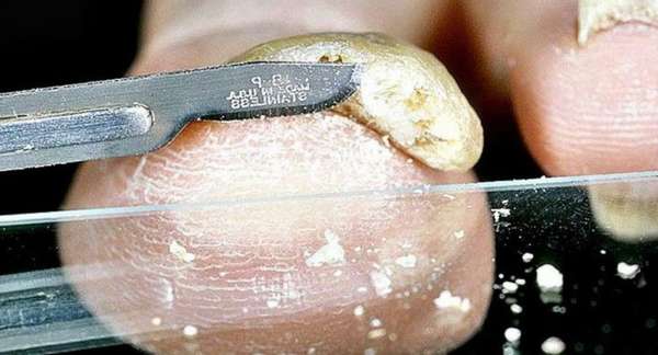 Обрезка ногтевой пластины