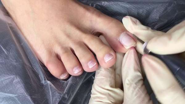 Обработка ногтя на ноге