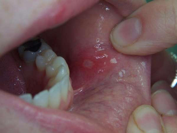 Воспаленная папиллома во рту