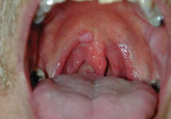 Папилломы на слизистой рта