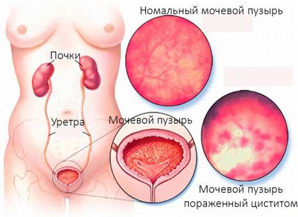 Нормальный мочевой пузырь и цистит