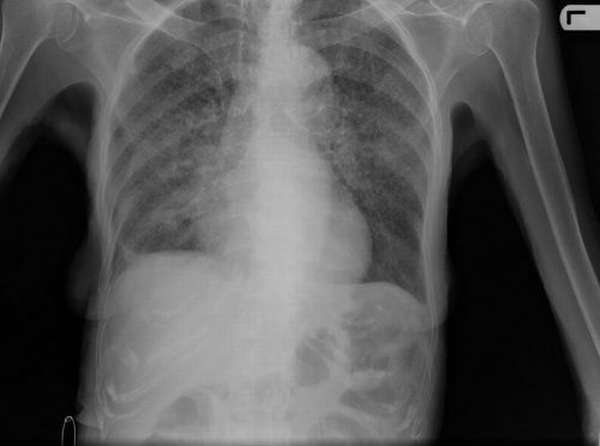 Рентген при милиарном туберкулезе
