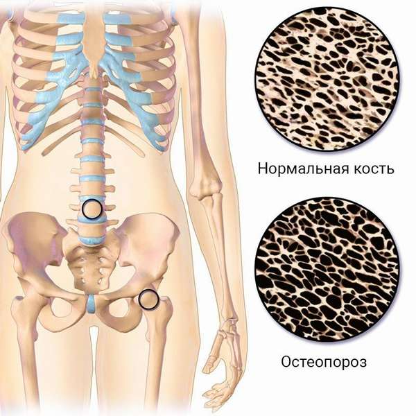 Нормальная кость и пораженная остеопорозом