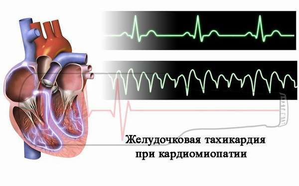 tachycardia